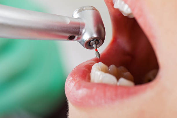 Best Emergency Tooth Extraction in College Park, GA